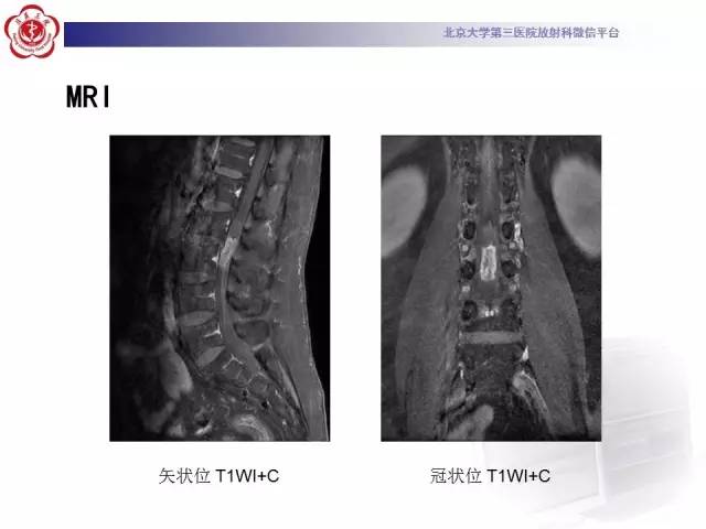 【病例】椎管内粘液乳头型室管膜瘤1例CT及MR