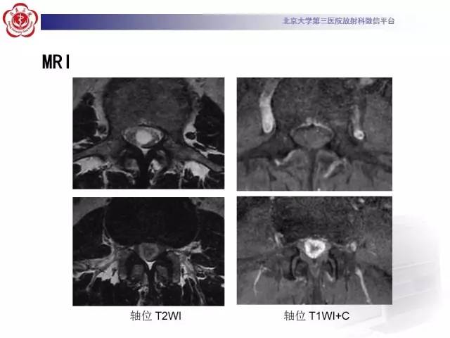 【病例】椎管内粘液乳头型室管膜瘤1例CT及MR