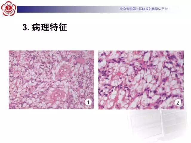 【病例】椎管内粘液乳头型室管膜瘤1例CT及MR