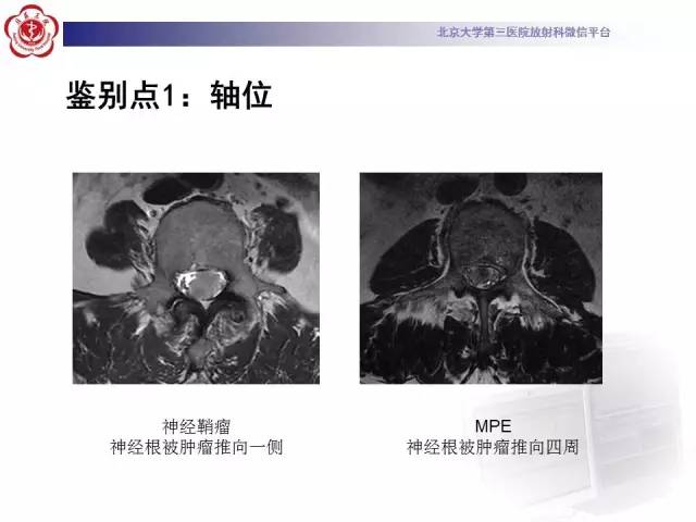 【病例】椎管内粘液乳头型室管膜瘤1例CT及MR