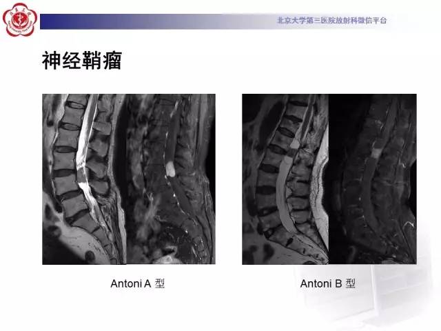 【病例】椎管内粘液乳头型室管膜瘤1例CT及MR