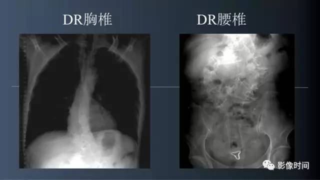 【病例】胸腰椎变异1例影像诊断分析