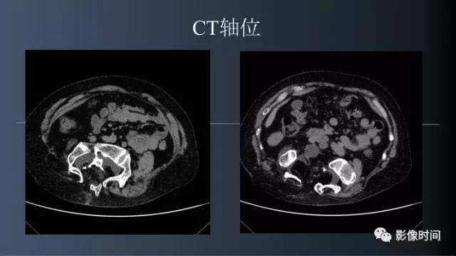 【病例】胸腰椎变异1例影像诊断分析