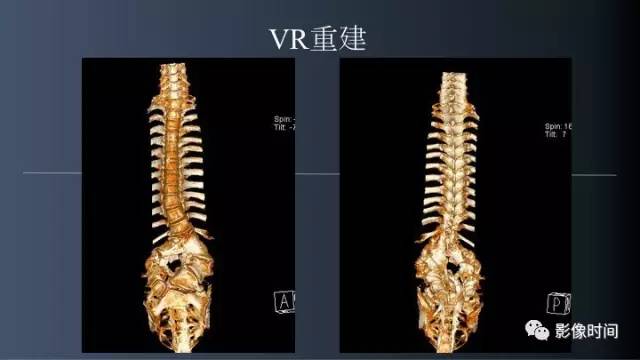 【病例】胸腰椎变异1例影像诊断分析