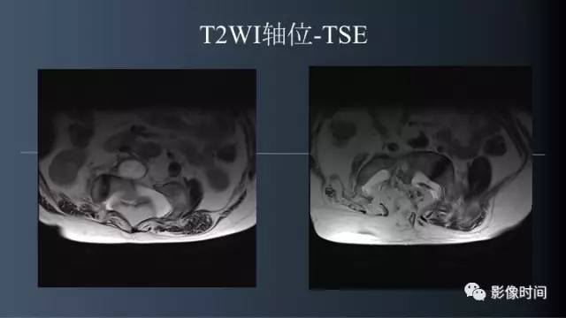 【病例】胸腰椎变异1例影像诊断分析