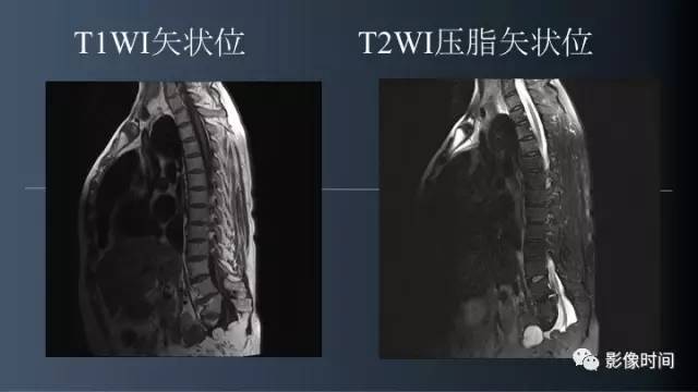 【病例】胸腰椎变异1例影像诊断分析