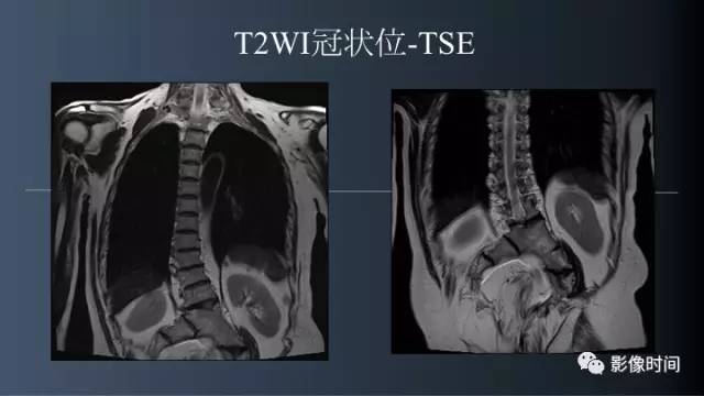 【病例】胸腰椎变异1例影像诊断分析
