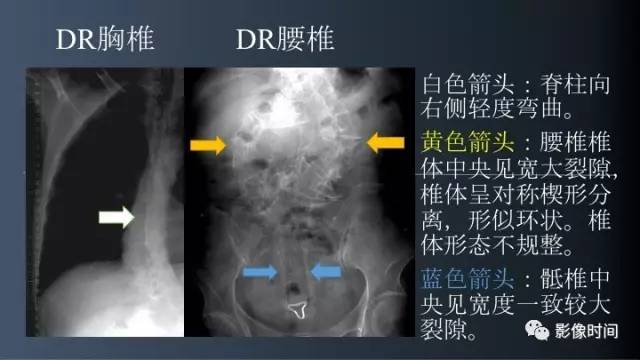 【病例】胸腰椎变异1例影像诊断分析