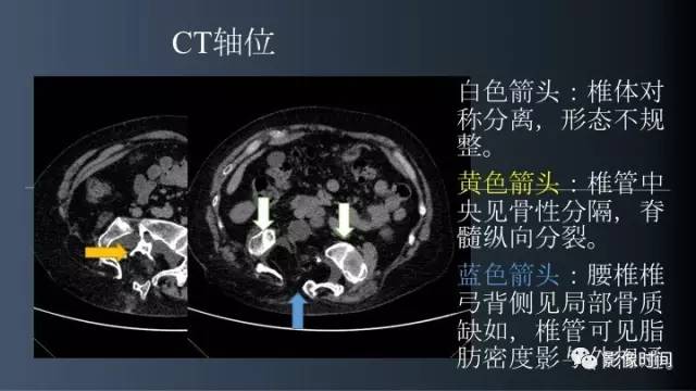 【病例】胸腰椎变异1例影像诊断分析