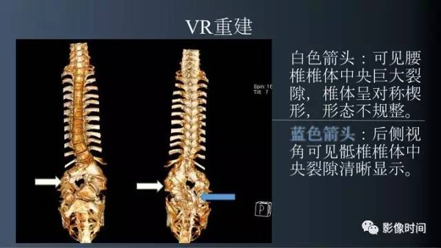 【病例】胸腰椎变异1例影像诊断分析