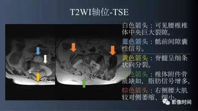【病例】胸腰椎变异1例影像诊断分析