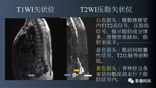 【病例】胸腰椎变异1例影像诊断分析