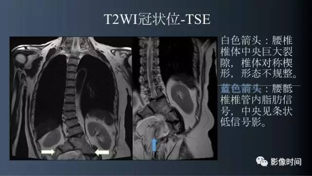【病例】胸腰椎变异1例影像诊断分析