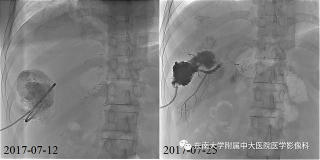 【病例】射频消融灶并发症—脓肿形成1例CT影像表现 【病例】射频消融灶并发症—脓肿形成1例CT影像表现