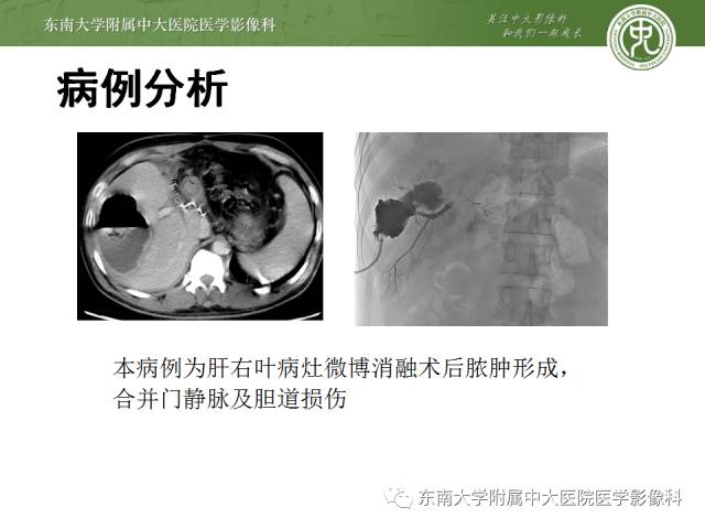【病例】射频消融灶并发症—脓肿形成1例CT影像表现 【病例】射频消融灶并发症—脓肿形成1例CT影像表现