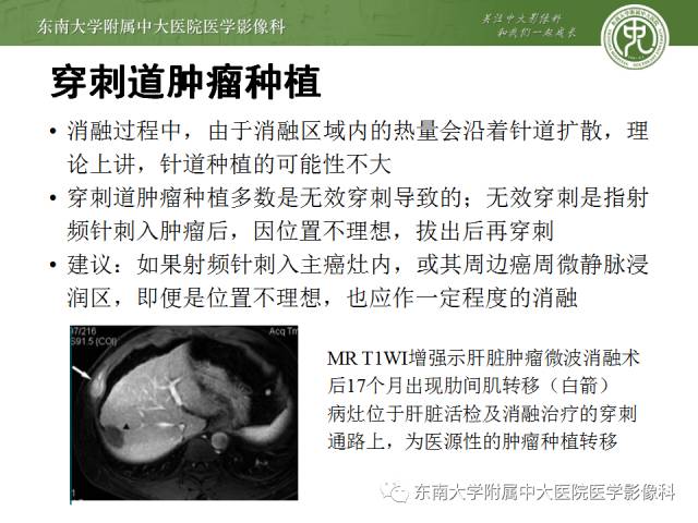 【病例】射频消融灶并发症—脓肿形成1例CT影像表现 【病例】射频消融灶并发症—脓肿形成1例CT影像表现