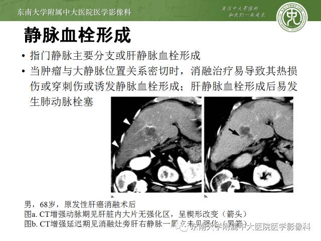 【病例】射频消融灶并发症—脓肿形成1例CT影像表现 【病例】射频消融灶并发症—脓肿形成1例CT影像表现