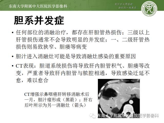 【病例】射频消融灶并发症—脓肿形成1例CT影像表现 【病例】射频消融灶并发症—脓肿形成1例CT影像表现