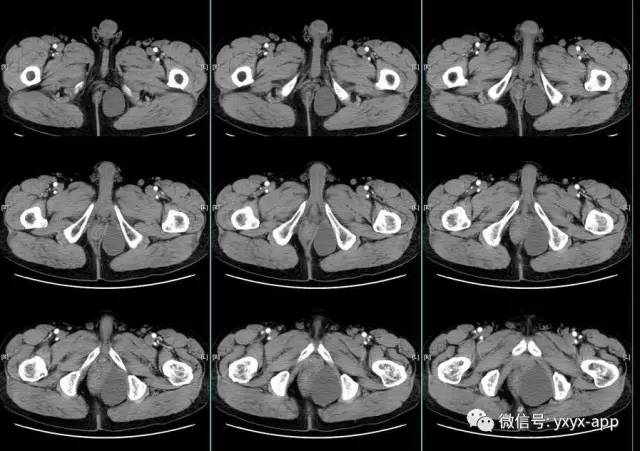 【病例】盆底左侧囊性站位—皮样囊肿1例CT 【病例】盆底左侧囊性站位—皮样囊肿1例CT