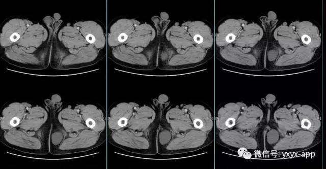 【病例】盆底左侧囊性站位—皮样囊肿1例CT 【病例】盆底左侧囊性站位—皮样囊肿1例CT
