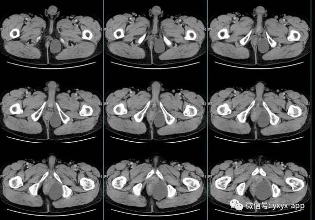 【病例】盆底左侧囊性站位—皮样囊肿1例CT 【病例】盆底左侧囊性站位—皮样囊肿1例CT