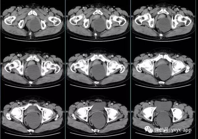 【病例】盆底左侧囊性站位—皮样囊肿1例CT 【病例】盆底左侧囊性站位—皮样囊肿1例CT