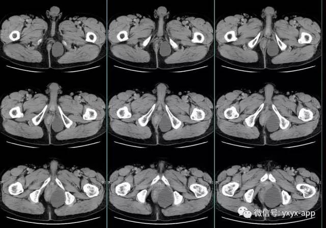 【病例】盆底左侧囊性站位—皮样囊肿1例CT 【病例】盆底左侧囊性站位—皮样囊肿1例CT