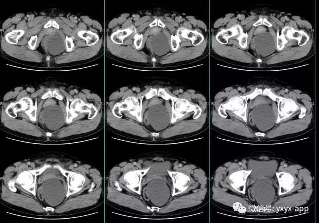 【病例】盆底左侧囊性站位—皮样囊肿1例CT 【病例】盆底左侧囊性站位—皮样囊肿1例CT