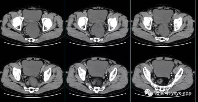 【病例】盆底左侧囊性站位—皮样囊肿1例CT 【病例】盆底左侧囊性站位—皮样囊肿1例CT