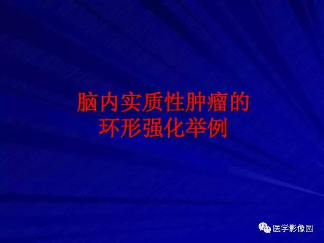 【PPT】颅内环状强化病变的影像学诊断及鉴别