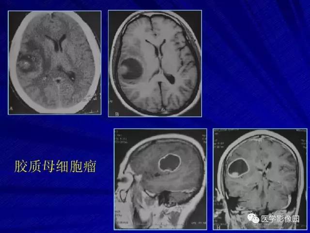【PPT】颅内环状强化病变的影像学诊断及鉴别
