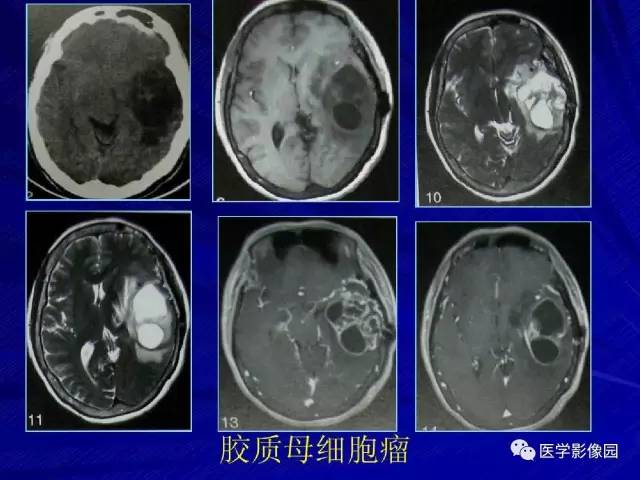 【PPT】颅内环状强化病变的影像学诊断及鉴别