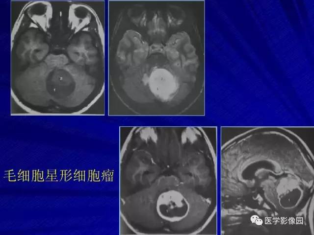 【PPT】颅内环状强化病变的影像学诊断及鉴别
