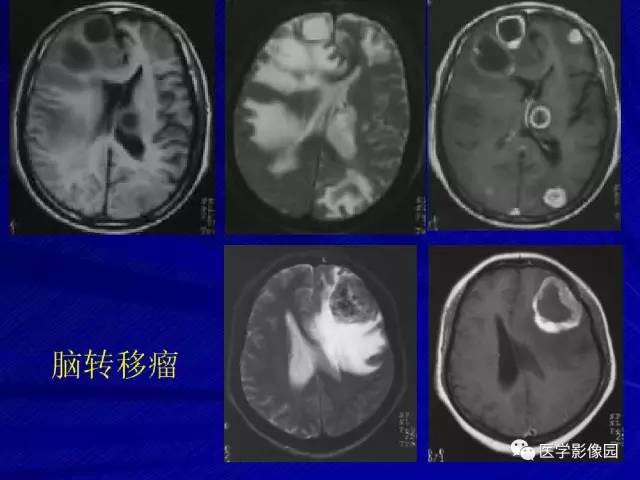 【PPT】颅内环状强化病变的影像学诊断及鉴别
