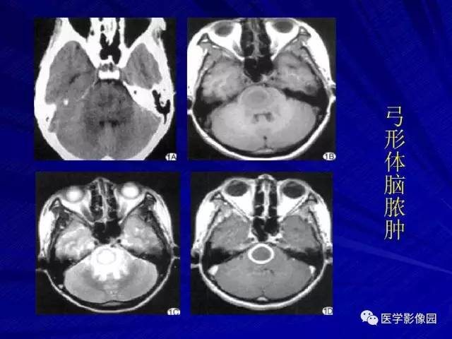 【PPT】颅内环状强化病变的影像学诊断及鉴别