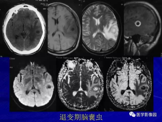 【PPT】颅内环状强化病变的影像学诊断及鉴别