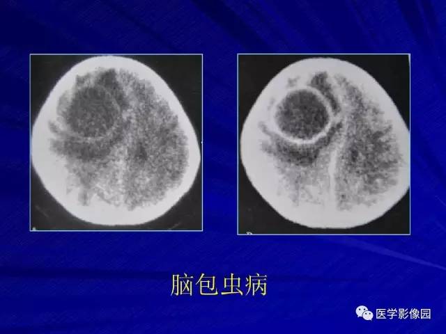 【PPT】颅内环状强化病变的影像学诊断及鉴别