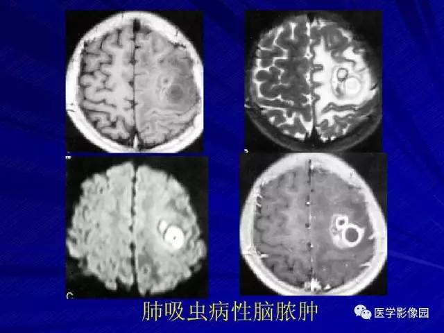 【PPT】颅内环状强化病变的影像学诊断及鉴别