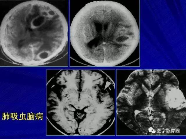 【PPT】颅内环状强化病变的影像学诊断及鉴别