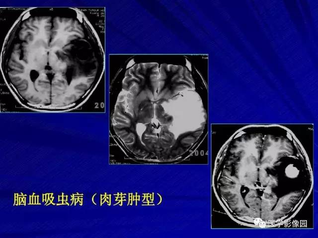 【PPT】颅内环状强化病变的影像学诊断及鉴别