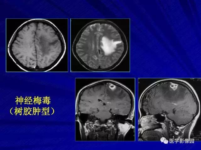 【PPT】颅内环状强化病变的影像学诊断及鉴别