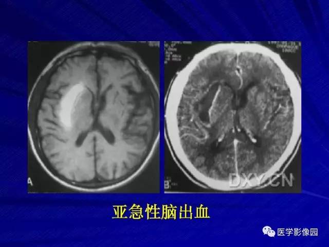 【PPT】颅内环状强化病变的影像学诊断及鉴别