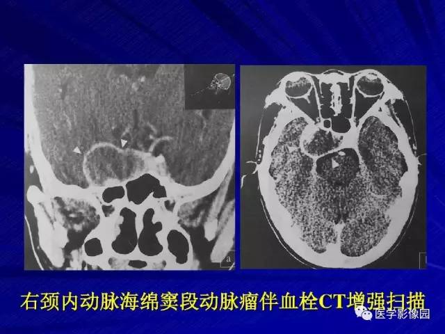 【PPT】颅内环状强化病变的影像学诊断及鉴别