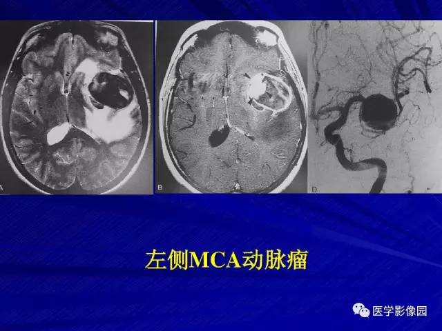 【PPT】颅内环状强化病变的影像学诊断及鉴别