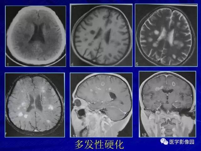 【PPT】颅内环状强化病变的影像学诊断及鉴别