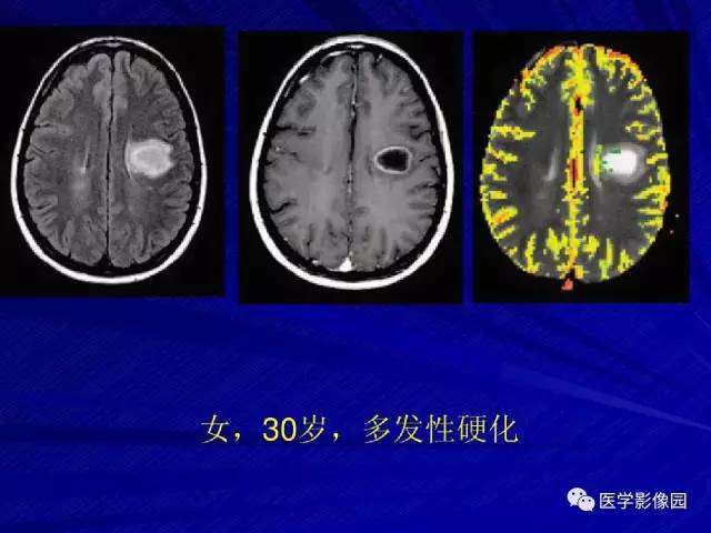 【PPT】颅内环状强化病变的影像学诊断及鉴别
