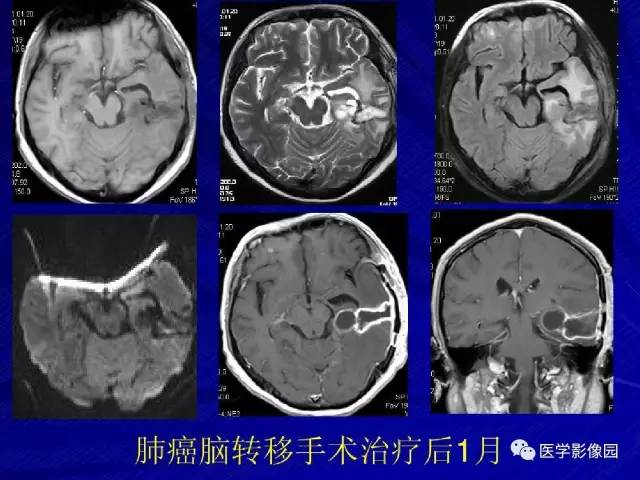 【PPT】颅内环状强化病变的影像学诊断及鉴别