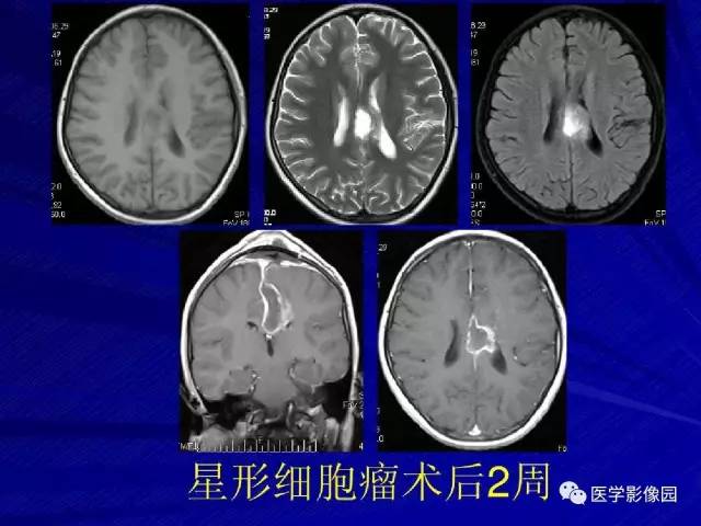【PPT】颅内环状强化病变的影像学诊断及鉴别