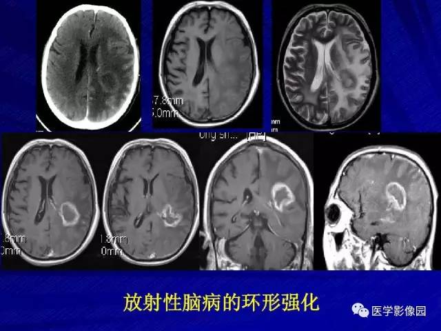 【PPT】颅内环状强化病变的影像学诊断及鉴别