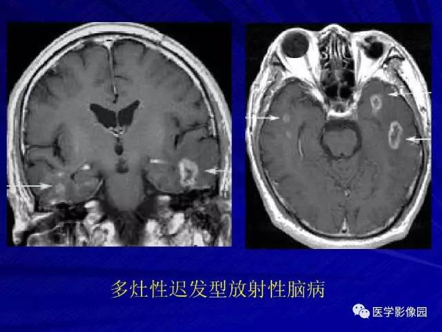 【PPT】颅内环状强化病变的影像学诊断及鉴别